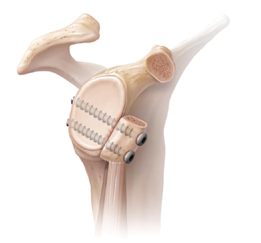 Shoulder and knee surgery Perth