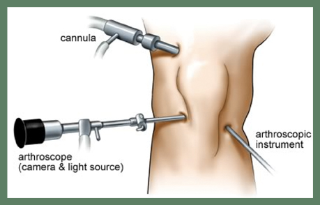 Knee Arthroscopy in Meerut