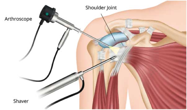 Shoulder Arthroscopy in Meerut