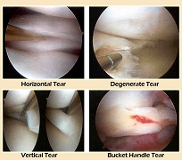 Arthroscopy in Meerut