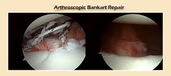 Shoulder Arthroscopy in Meerut