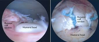 Shoulder Arthroscopy in Meerut