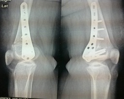 Knee Replacement in Meerut Image 1