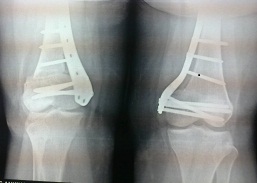 Knee Replacement in Meerut Image 2