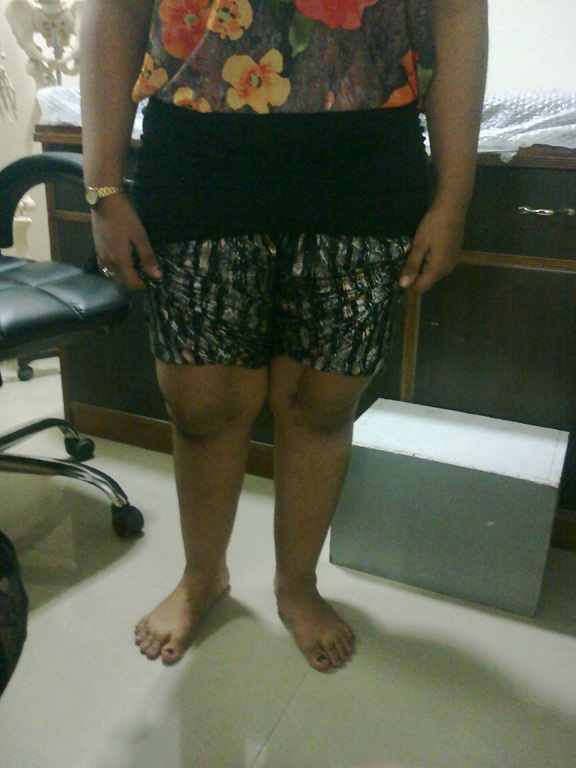 Knee Replacement in Meerut Image 3