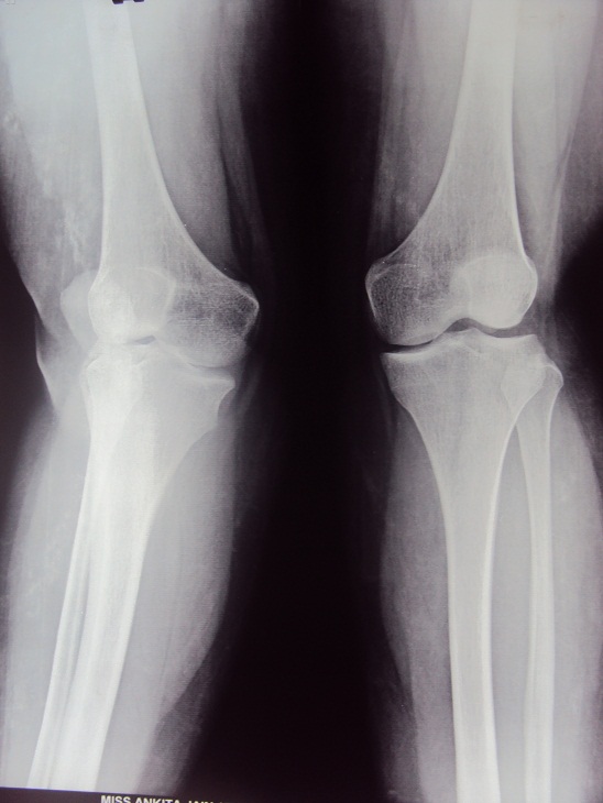Knee Replacement in Meerut Image 4