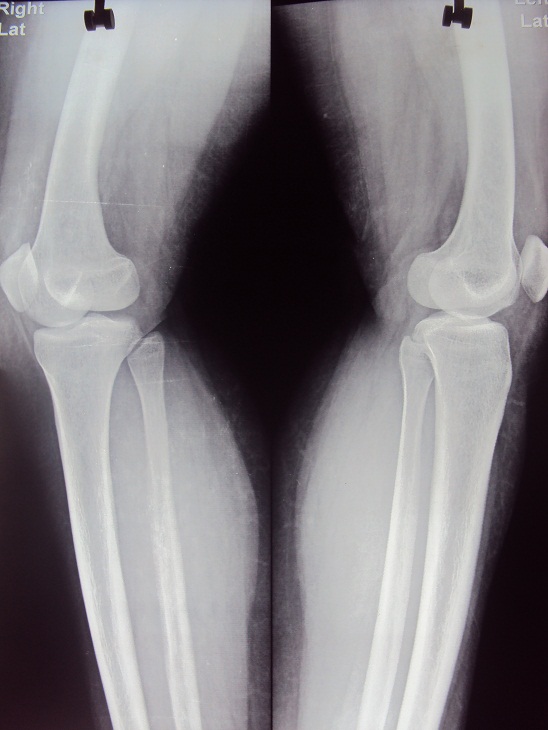 Knee Replacement in Meerut Image 5