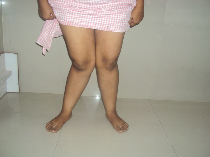 Knee Replacement in Meerut Image 6