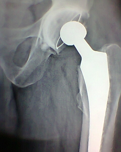 Cemented Hip Replacement in Meerut Image 1