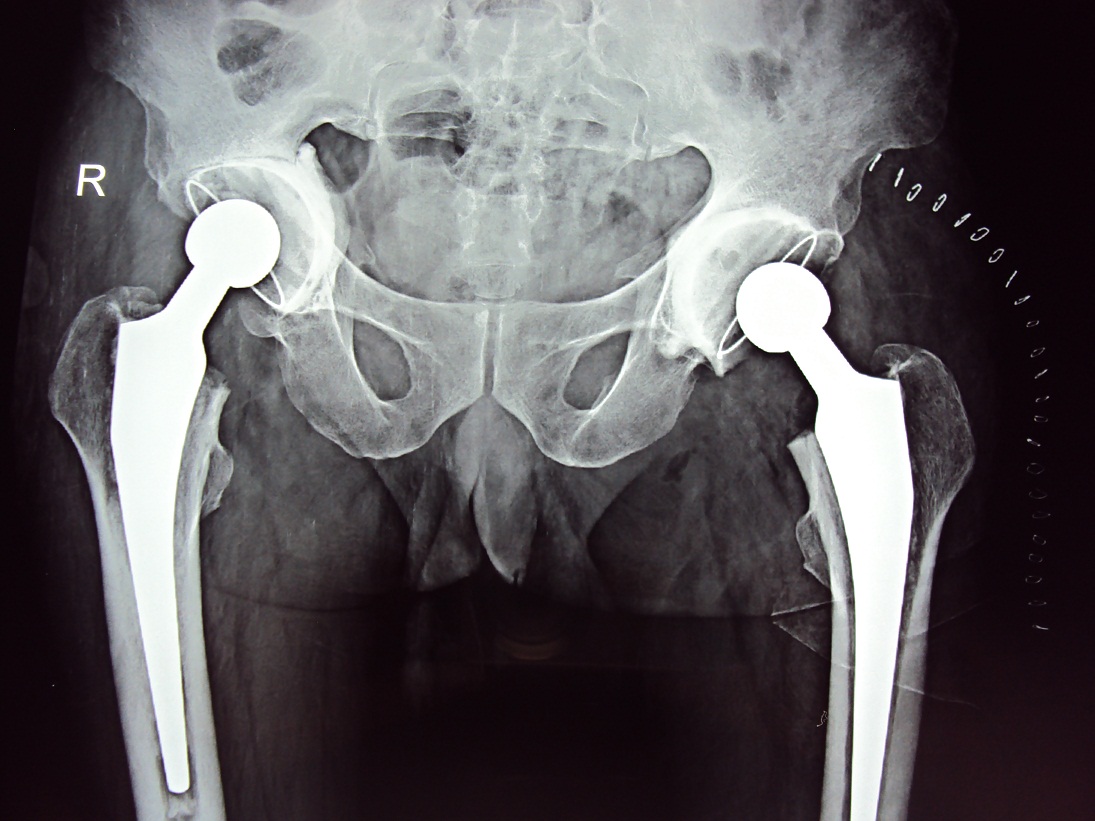 Cemented Hip Replacement in Meerut Image 3