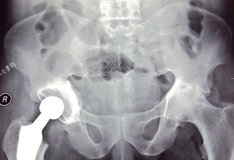 Cemented Hip Replacement in Meerut Image 4