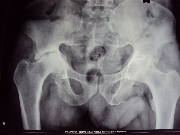 Cemented Hip Replacement in Meerut Image 5
