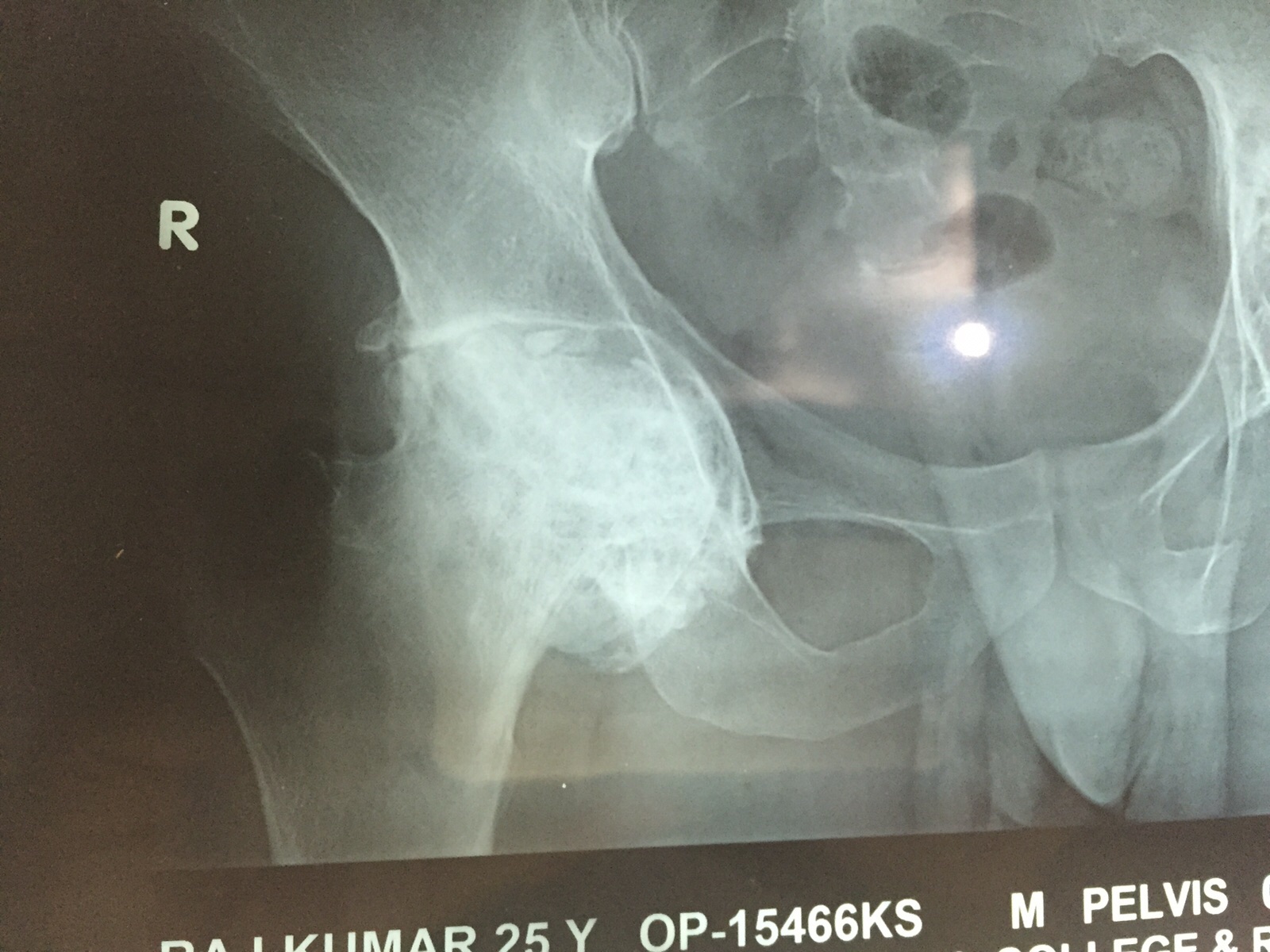 Uncmented Hip Replacement in Meerut Image 1