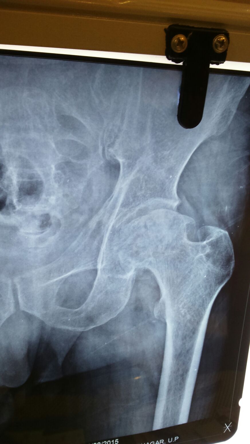 Uncmented Hip Replacement in Meerut Image 2