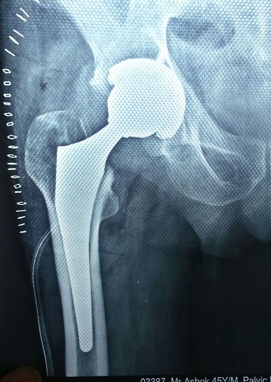 Uncmented Hip Replacement in Meerut Image 3