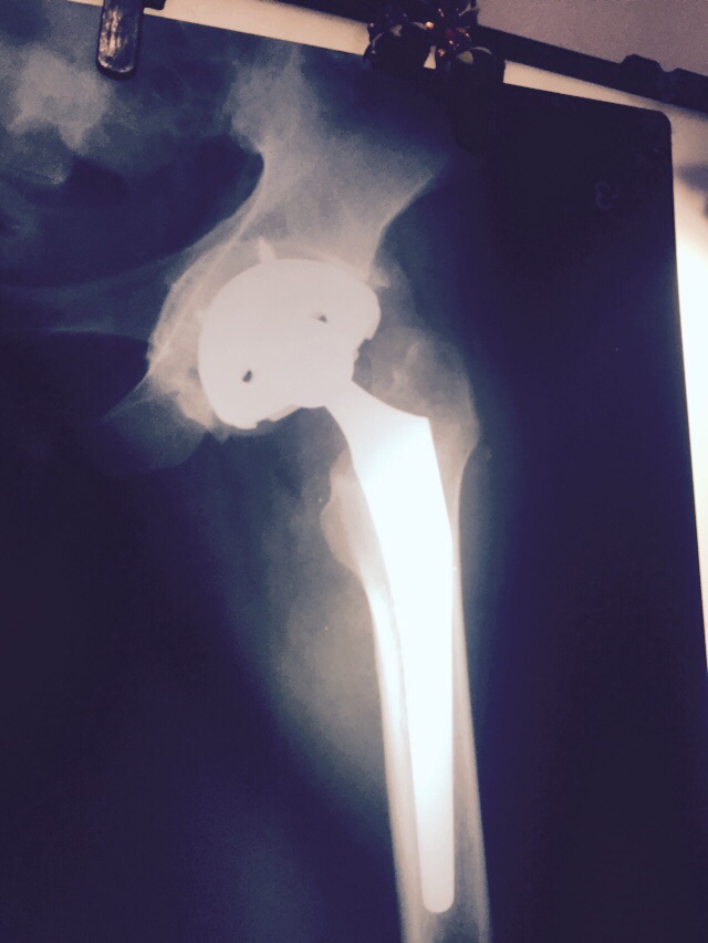 Uncmented Hip Replacement in Meerut Image 4