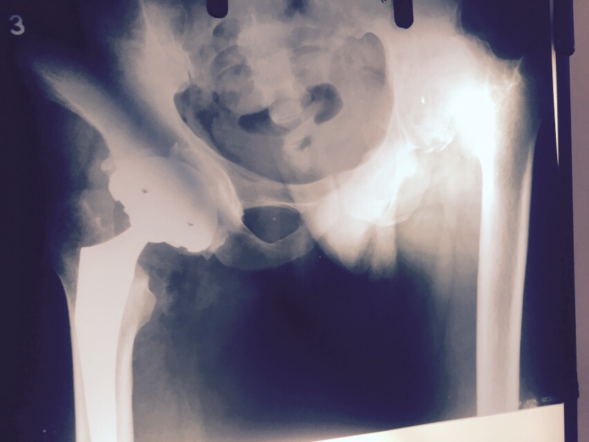 Uncmented Hip Replacement in Meerut Image 5