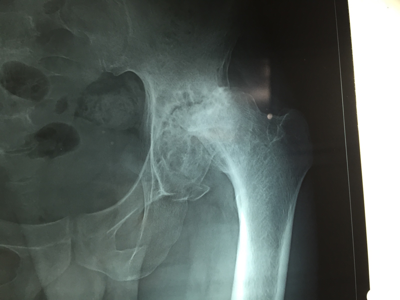 Uncmented Hip Replacement in Meerut Image 6