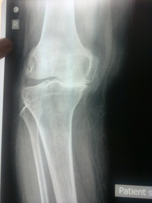 Total Knee Replacement in Meerut Image 1