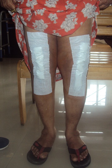 Total Knee Replacement in Meerut Image 2