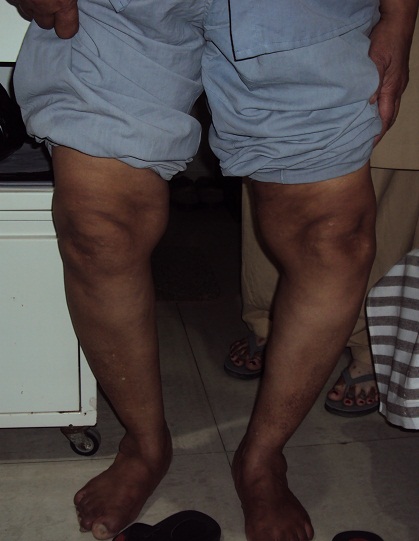 Total Knee Replacement in Meerut Image 3