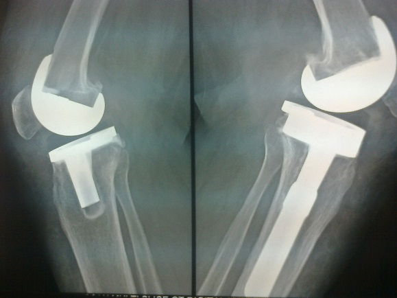 Total Knee Replacement in Meerut Image 4