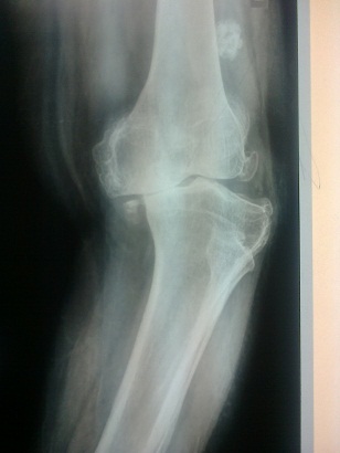 Total Knee Replacement in Meerut Image 6
